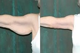 Best Arm Lift Surgery Riyadh